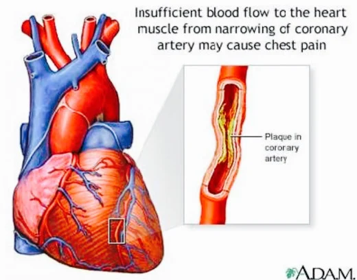 Angina is a problem