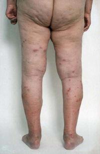 Inflamatory body